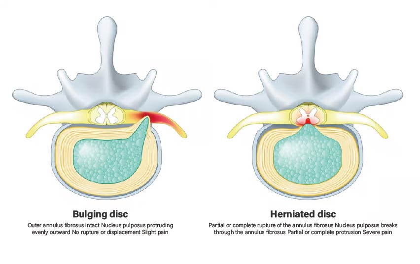 What is the difference between bulging discs and herniated discs.jpg